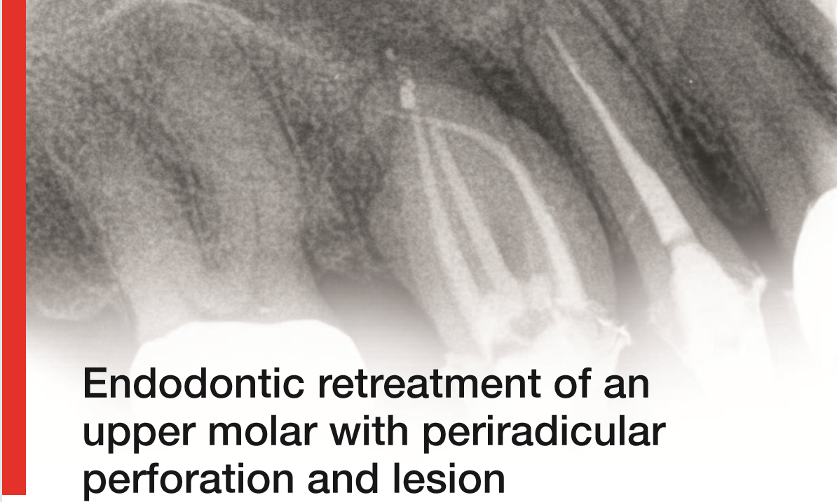 CSC14_bioroot Endodontic Retreatment of an Upper Molar With Periradicular Perforation and Lesion