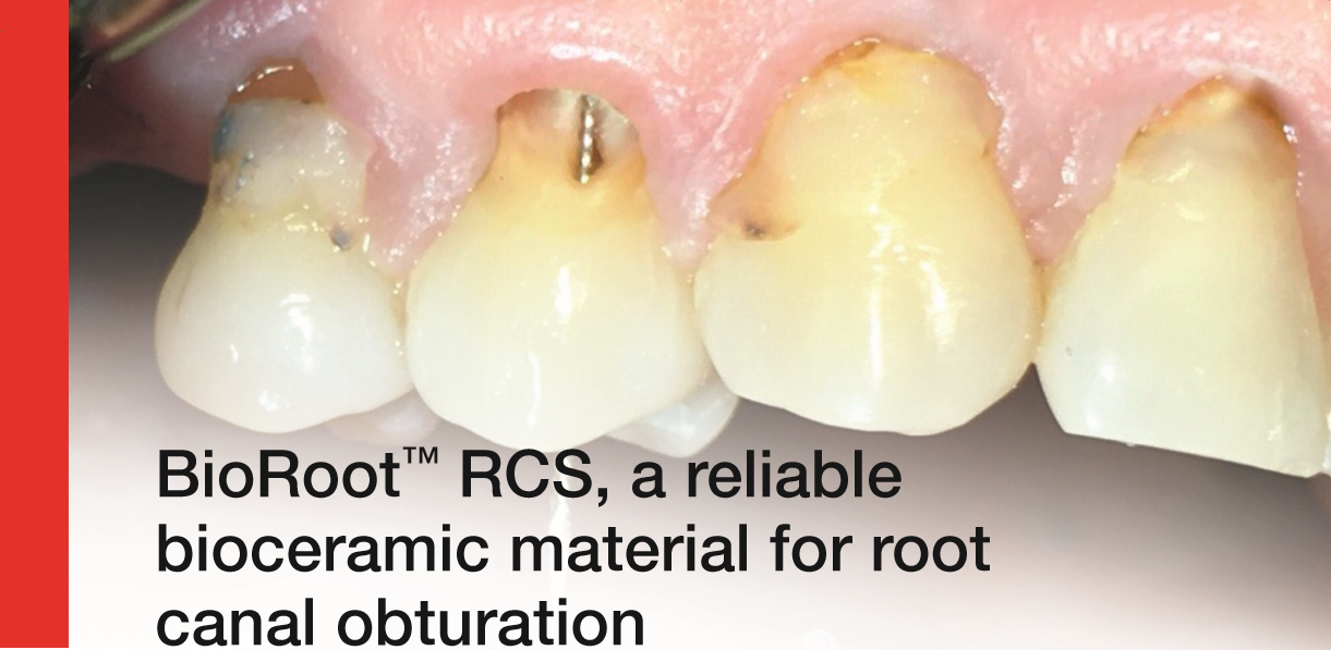CSC15_BioRoot™ RCS, a reliable bioceramic material for root canal obturation