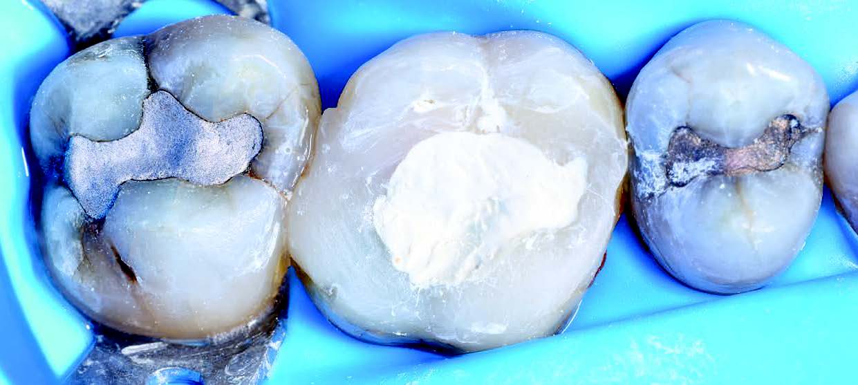 Case Studies Collection 28 - Vier exclusieve casestudies over diepe caviteiten en gebarsten tanden Case Studies Collection 28 - Vier exclusieve casestudies over diepe caviteiten en gebarsten tanden