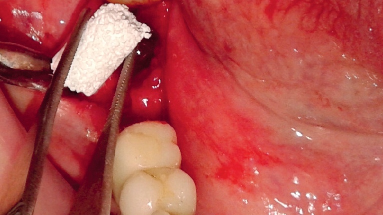 Alveolar ridge preservation with alloplastic material