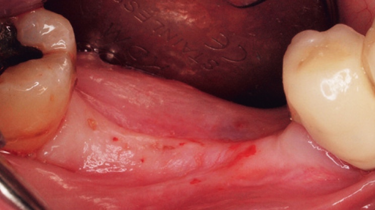 Clinical case of alveolar ridge preservation with alloplastic material: results at 6 months