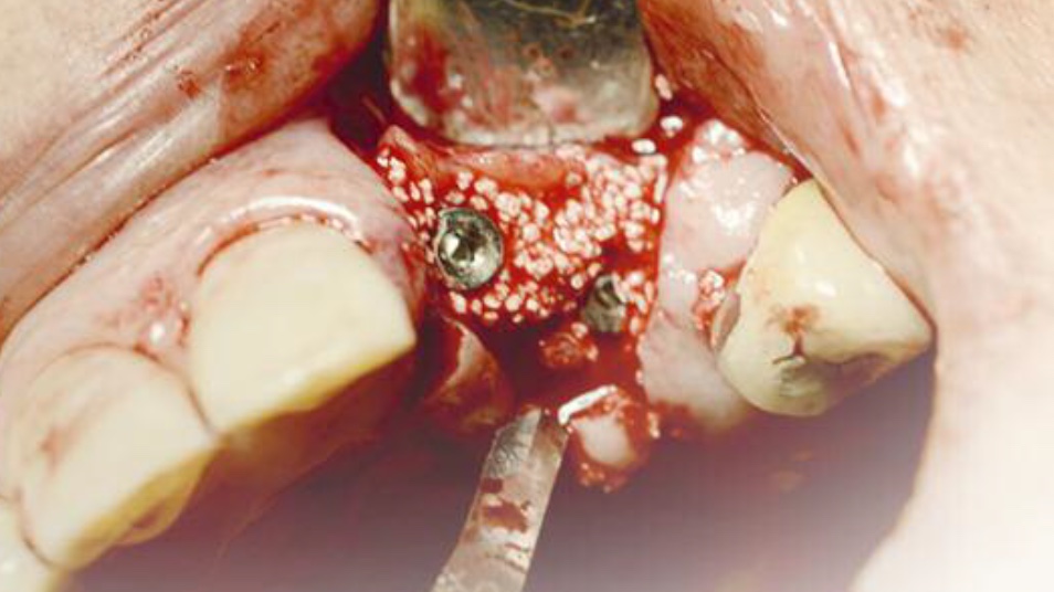 Use of ß-tricalcium phosphate for bone regeneration in oral surgery