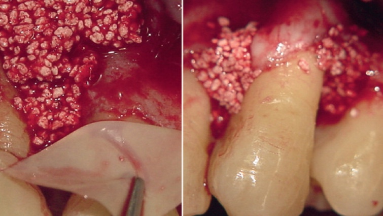  Periodontal intraoseous defects and post-extraction compromised socket. Treatment with beta tricalcium phosphate