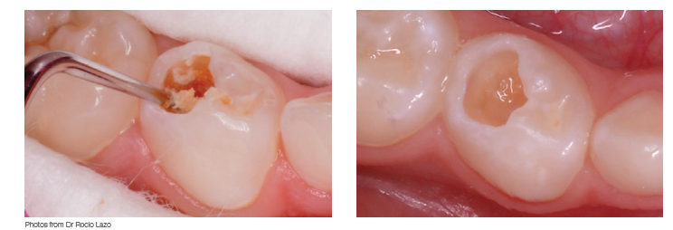 ART: Minimaliseren van de druppel- en aërosolvorming met ART-techniek en Biodentine 6