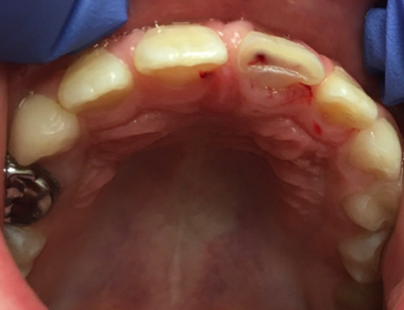 Waarom is het zo belangrijk voor tandartsen om de pulpa bij tanden van kinderen te behouden? 1