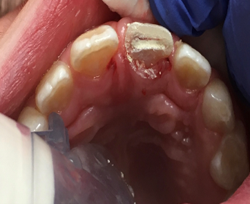 Waarom is het zo belangrijk voor tandartsen om de pulpa bij tanden van kinderen te behouden? 3