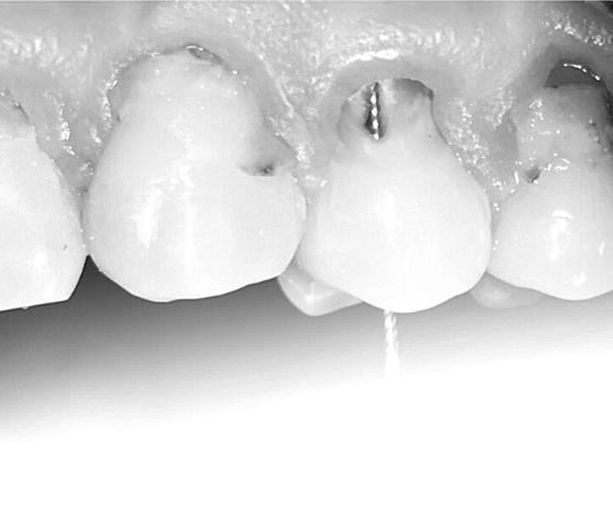 Tooth with bioceramic material for root canal obturation
