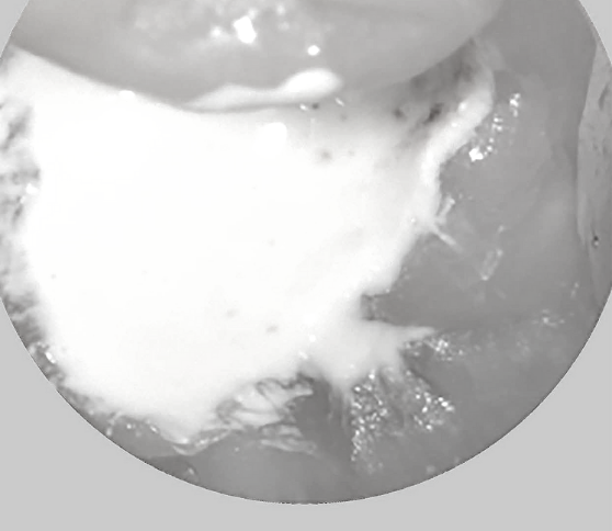 Full Pulpotomy in Mature Teeth with Irreversible Pulpitis and Apical Periodontitis