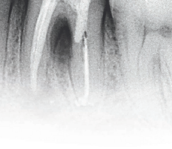 Biodentine in the management of complex root perforation